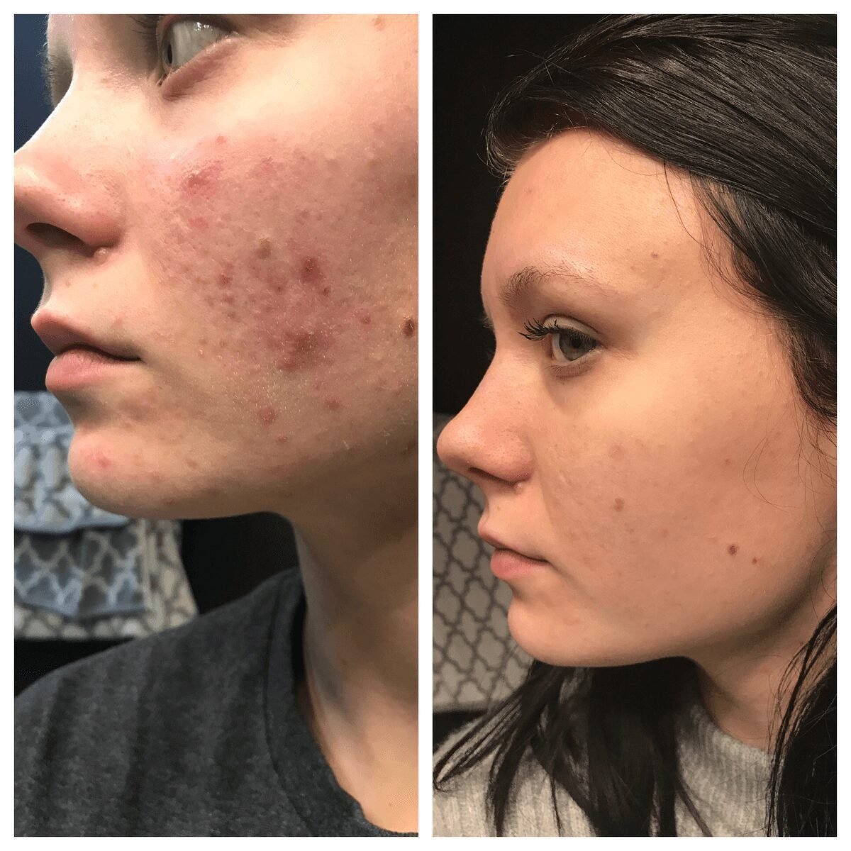 A side-by-side before and after comparison of a woman's face, showing acne and blemishes on the left panel and clearer skin on the right panel.